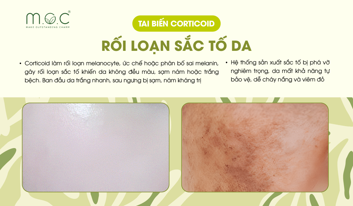 Tai biến da nhiễm Corticoid: Rối loạn sắc tố da