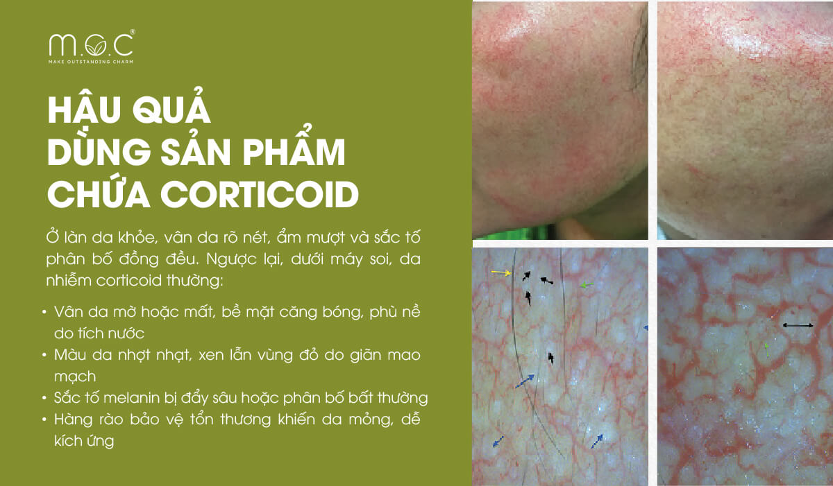 Những tác hại của corticoid trên da