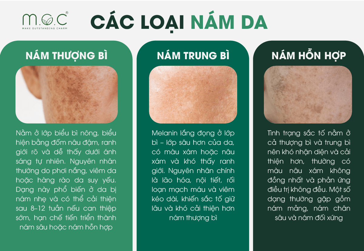 Các loại nám gồm nám mảng, nám chân sâu và nám hỗn hợp