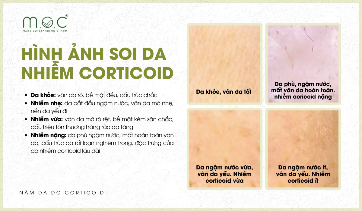 Hình ảnh soi da nhiễm Corticoid