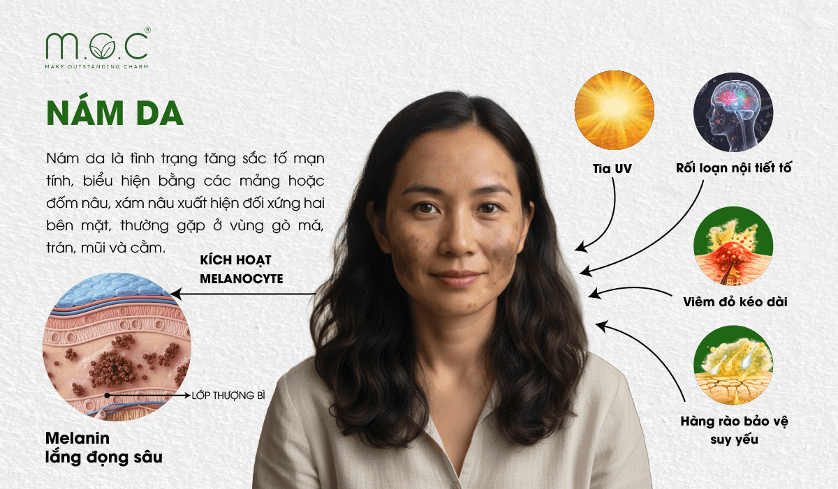 Nám da là tình trạng tăng sắc tố mạn tính, biểu hiện bằng các mảng hoặc đốm nâu, xám nâu xuất hiện đối xứng hai bên mặt, thường gặp ở vùng gò má, trán, mũi và cằm