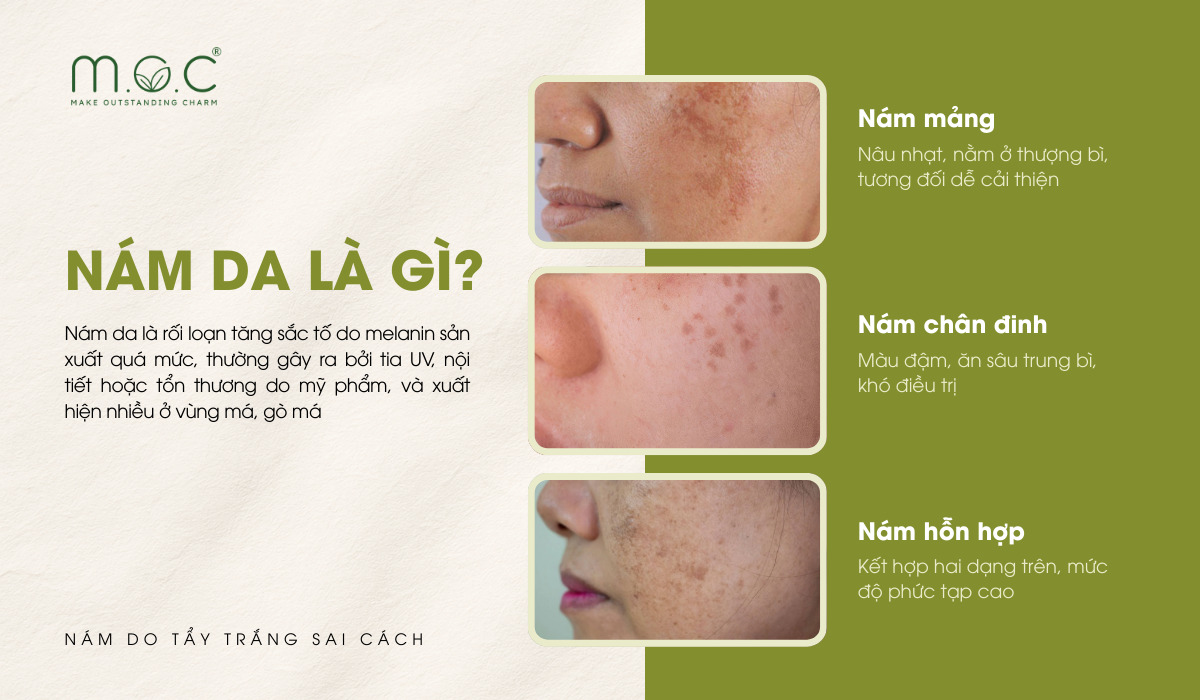 Nám da hình thành khi tế bào melanocyte tăng sản xuất melanin quá mức và phân bố không đồng đều dưới biểu bì hoặc trung bì