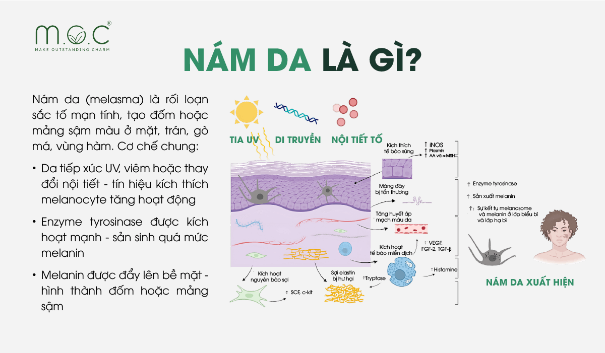 Nám da là tình trạng xuất hiện các mảng sẫm màu do melanin tăng sinh và tích tụ không đều trên da