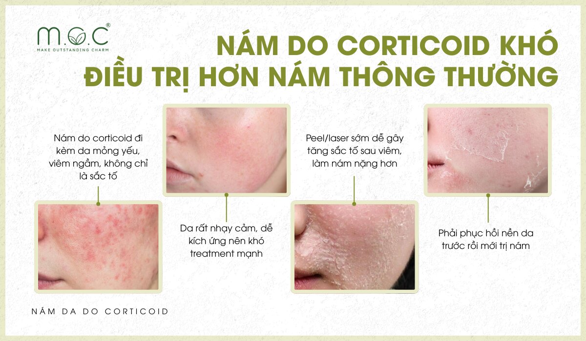 Vì sao nám do corticoid khó cải thiện hơn nám thông thường?