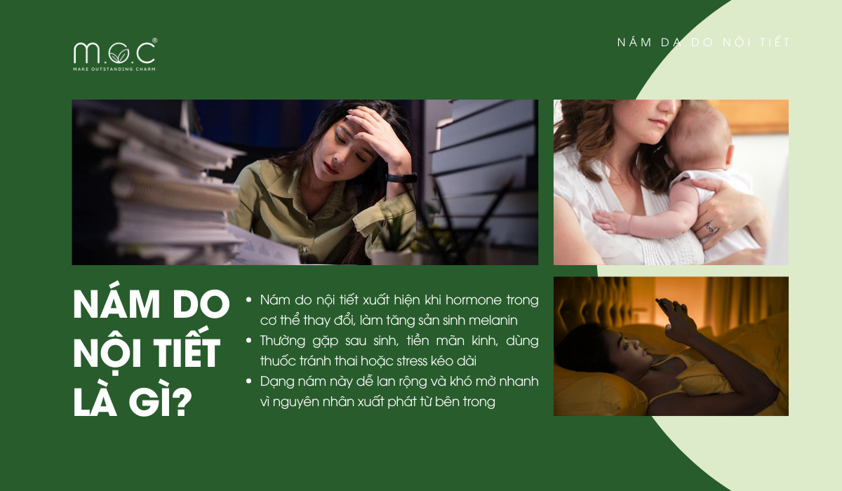 Nám do nội tiết xuất hiện khi hormone trong cơ thể thay đổi mạnh, kích thích tế bào sắc tố hoạt động quá mức