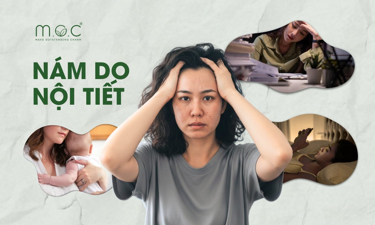 nám do nội tiết