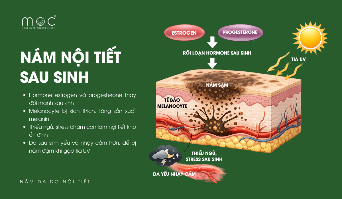 Sau sinh là giai đoạn cơ thể phụ nữ trải qua biến động nội tiết mạnh nhất, khiến nám dễ xuất hiện hoặc đậm rõ hơn