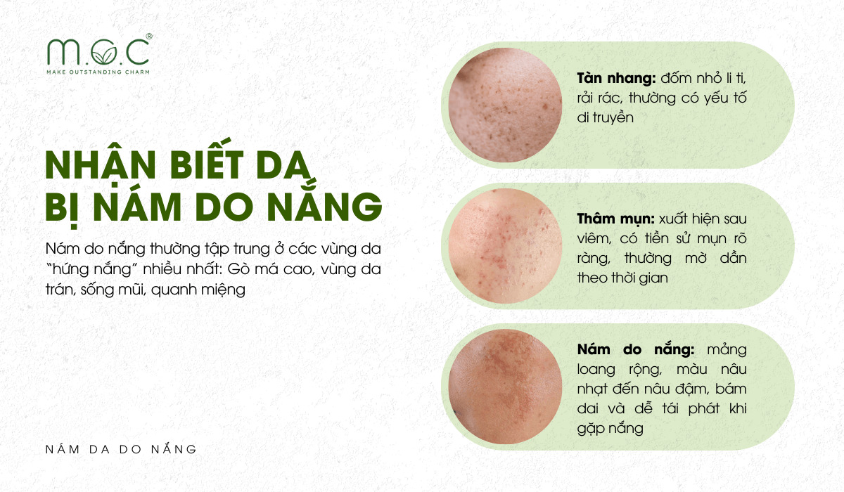 Cách nhận biết nám do nắng