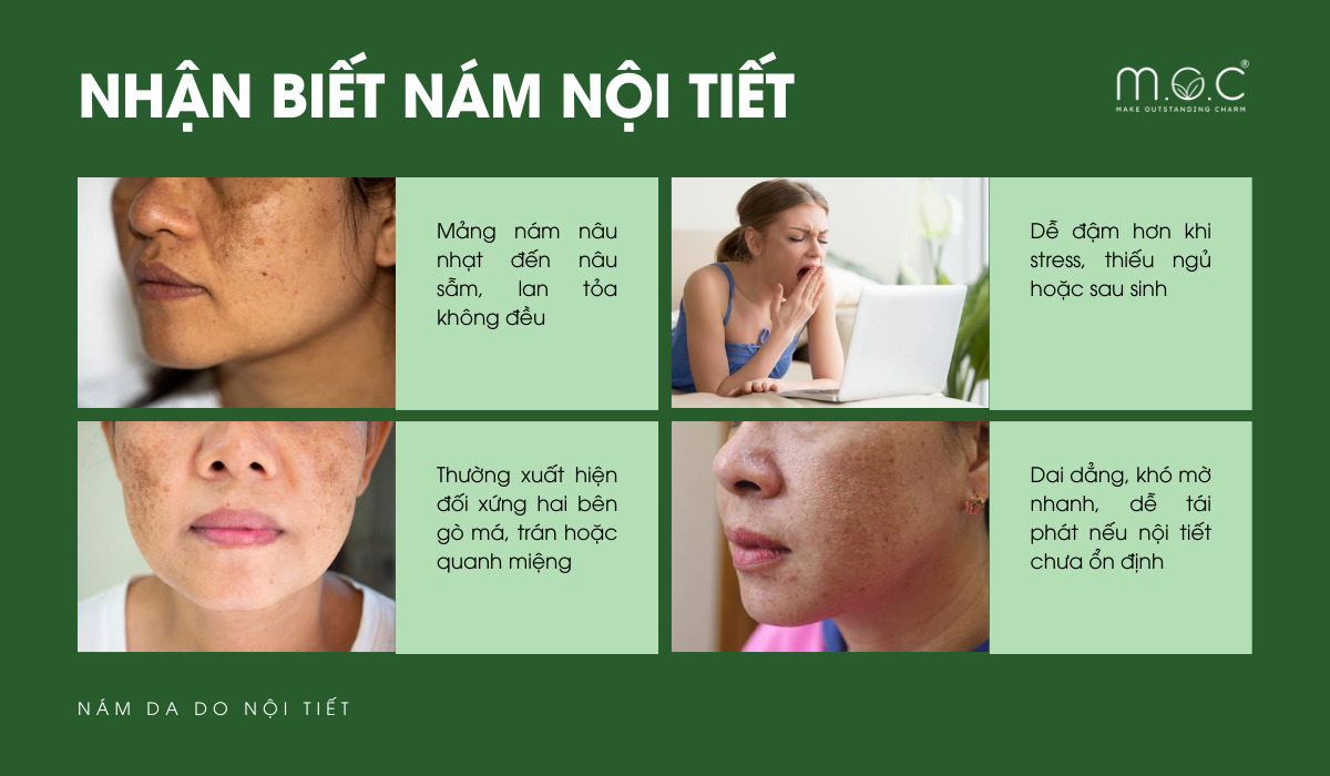 Cách nhận biết nám do nội tiết