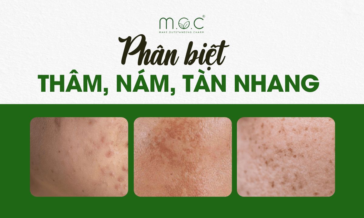 Phân biệt thâm mụn, nám da, tàn nhang