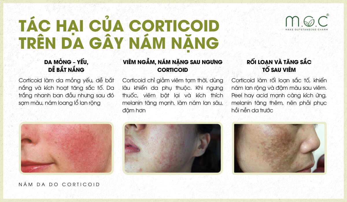 Những tác hại của corticoid trên da gây nám nặng hơn