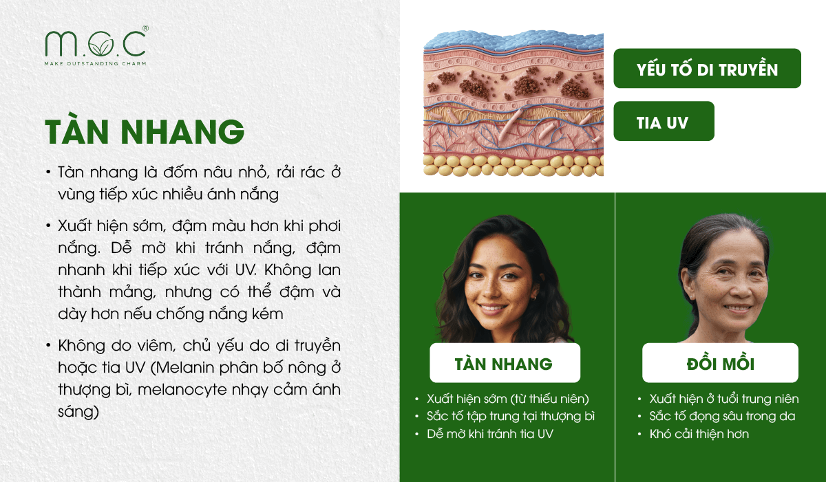 Tàn nhang là dạng tăng sắc tố có yếu tố di truyền rõ rệt, thường xuất hiện sớm và đậm màu hơn khi tiếp xúc ánh nắng