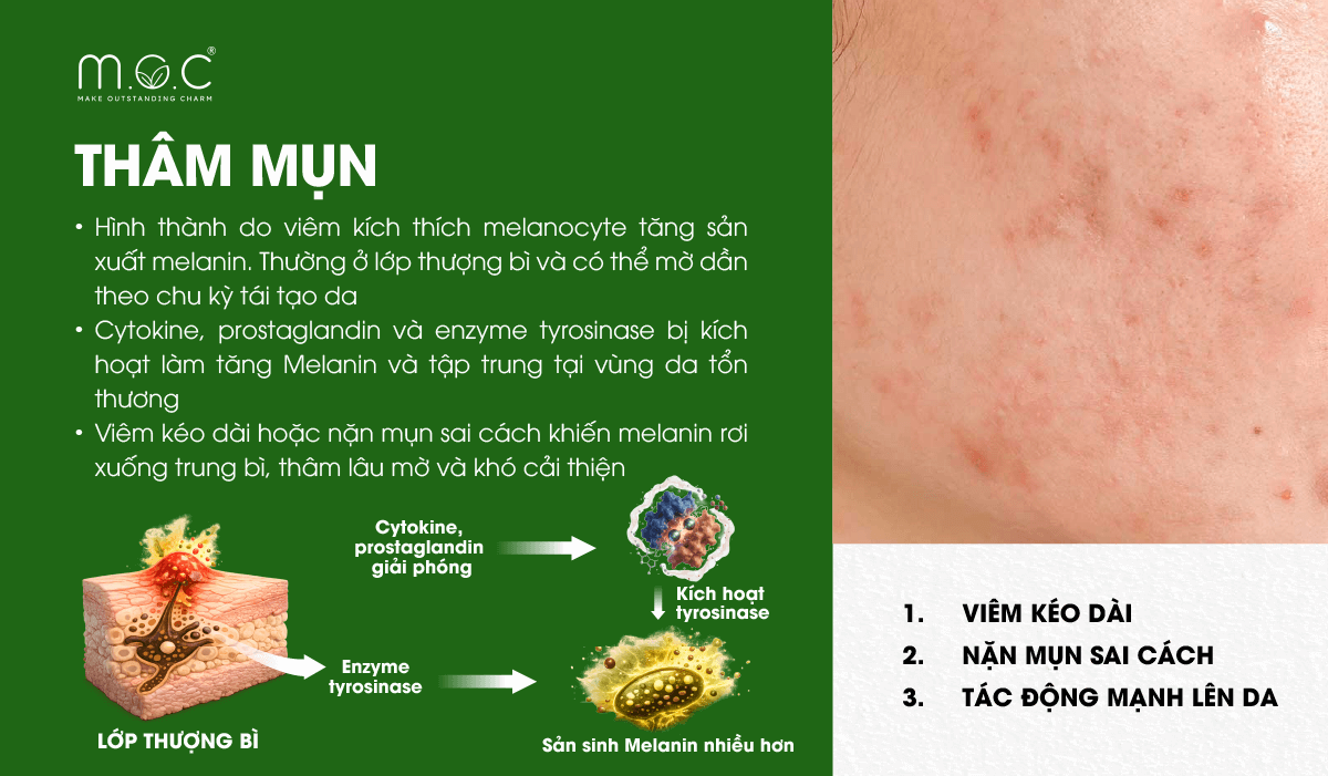 Thâm mụn là tình trạng tăng sắc tố sau viêm (PIH), thường xuất hiện sau các tổn thương viêm do mụn