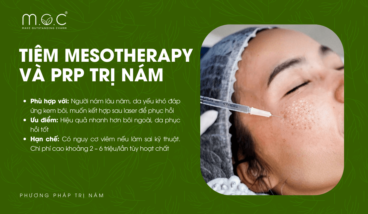 Tiêm Mesotherapy và PRP để trị nám da